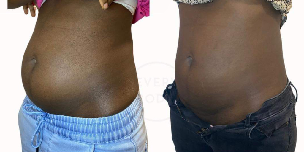 Body Sculpting with Fat Cavitation & Radio Frequency Near Me