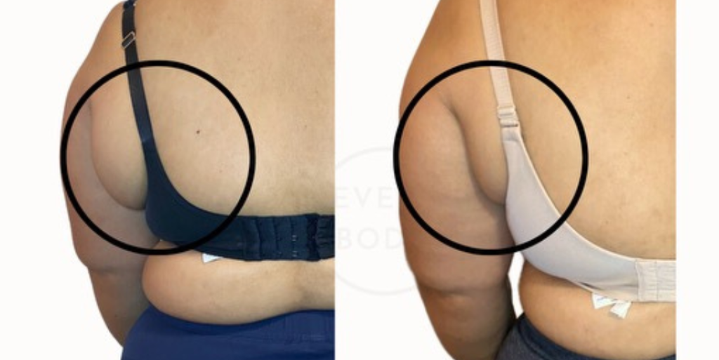 Everybody Clinics | Body Sculpting with Fat Cavitation & Radio Frequency