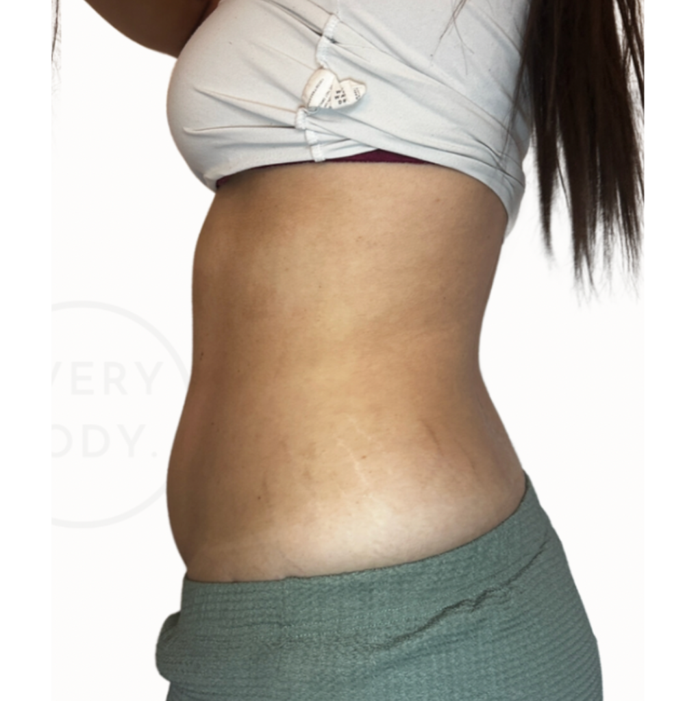 Body Sculpting with Fat Cavitation & Radio Frequency