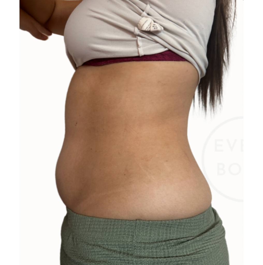 Brisbane Body Sculpting with Fat Cavitation & Radio Frequency